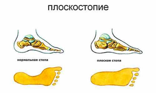 плоскостопие у детей: лечение и профилактика при помощи различных методов